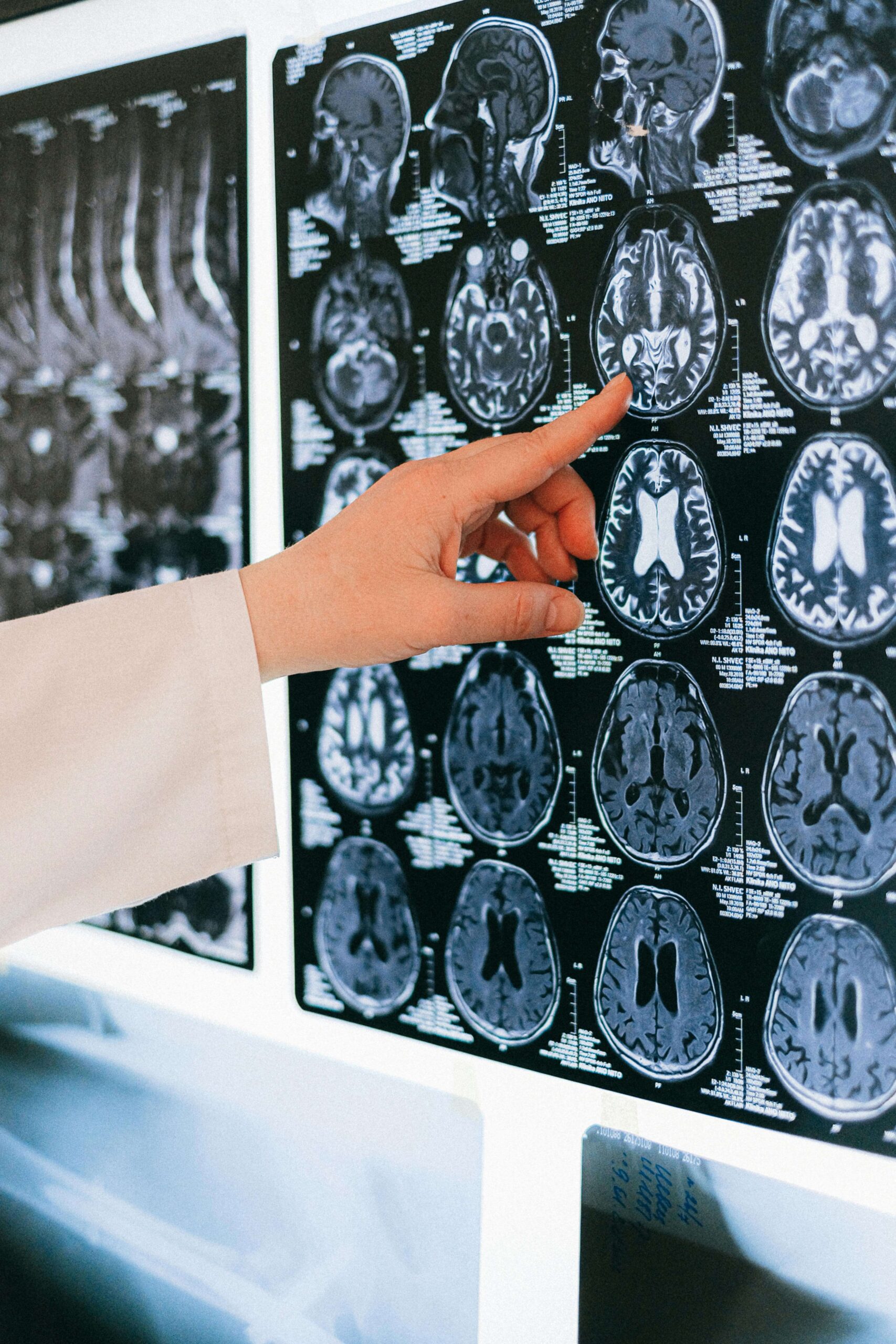 Antioch brain injury attorneys- hand pointing at brain injury scan